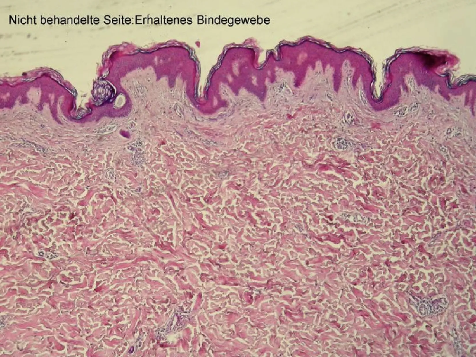 毛穴が大きくなり表皮がたるんだ肌