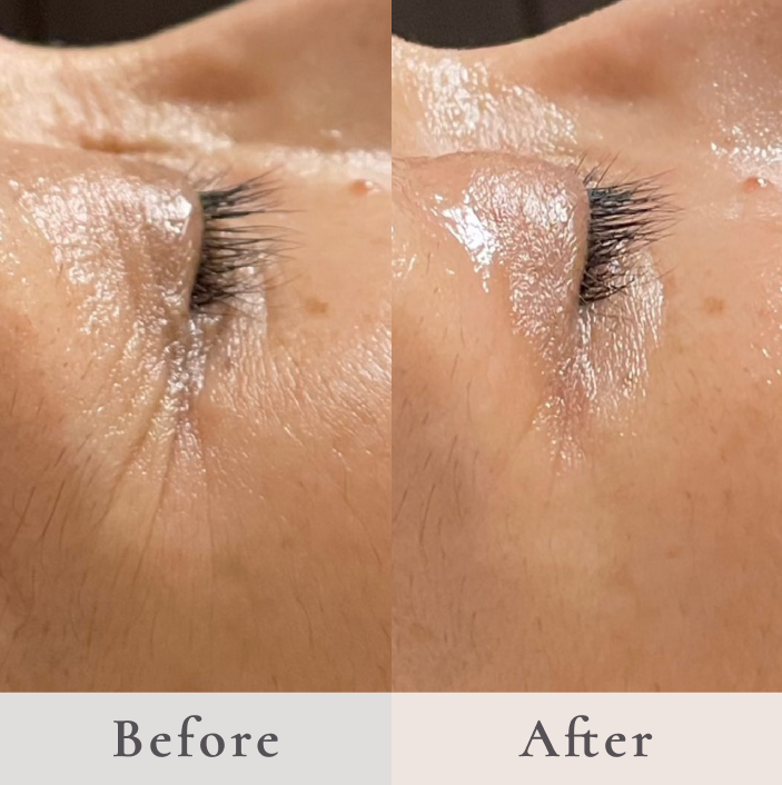 シワ・タルミの原因となる筋肉に直接アプローチする 世界にひとつのリフティングメソッド